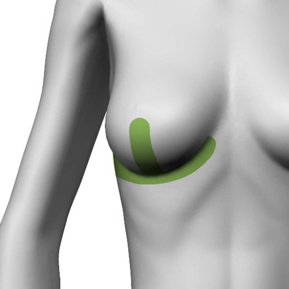 Adhesive silicone gel sheet for scar treatment, Anchor shape